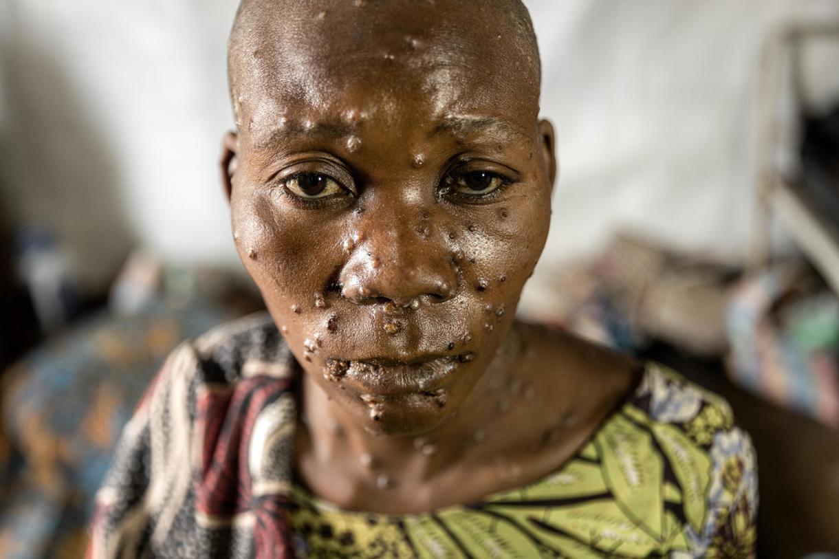 Sifa Mwakasisi, de 30 años, paciente de Mpox, observa mientras recibe tratamiento en el hospital Kavumu en Karanrhada, Kamavu, provincia de Kivu del Sur, República Democrática del Congo, el 3 de septiembre de 2024. (Niza) (Foto de Michael Lunanga de la agencia EFE/EPA)