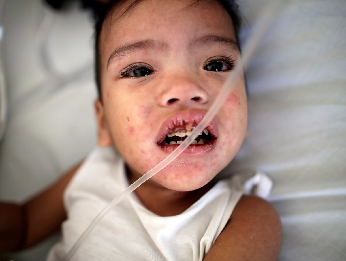 Un niño enfermo de sarampión. (Foto de archivo Francis R. Malasig de la agencia EFE)